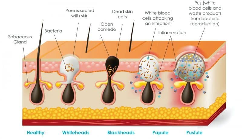 Diagram illustrating different types of acne