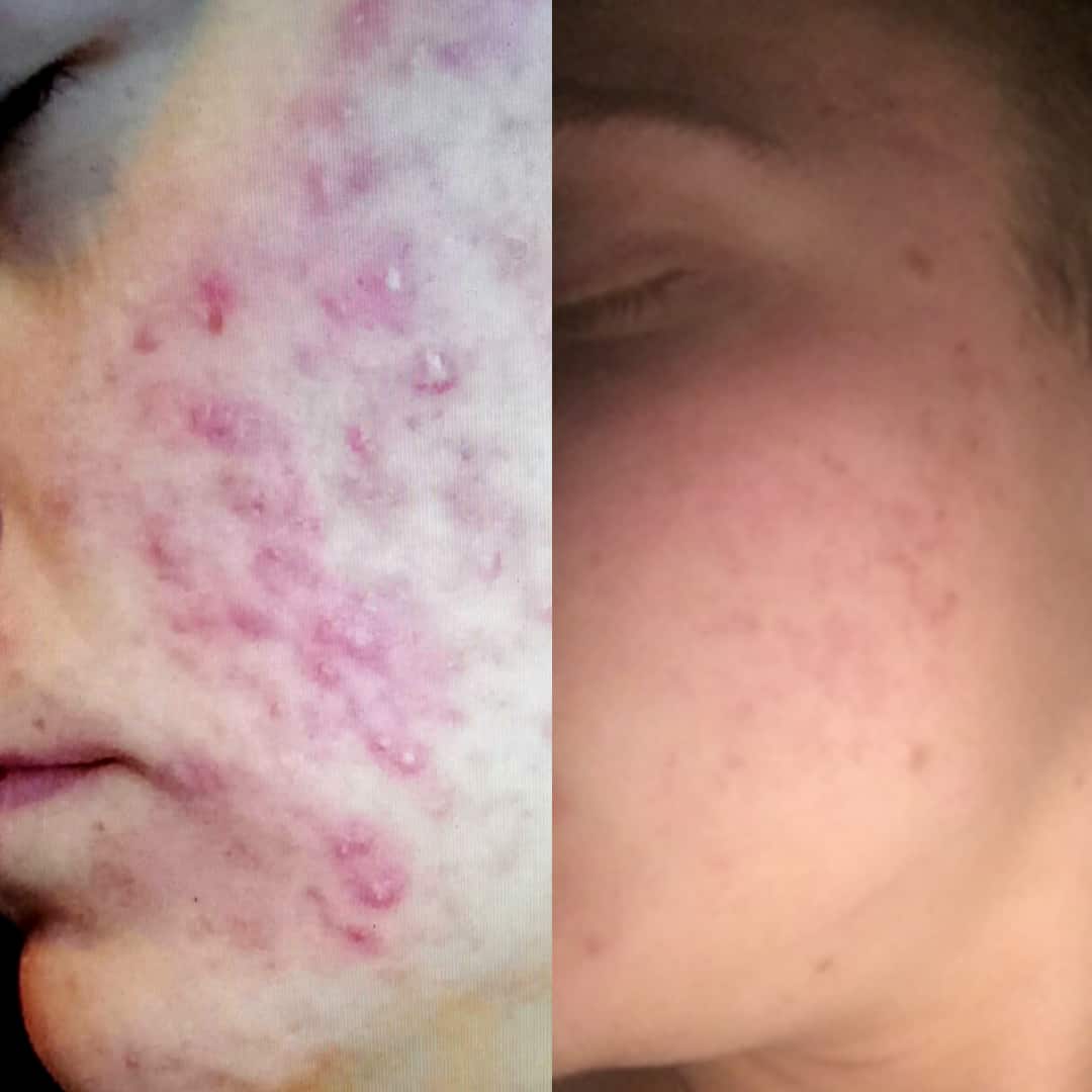 Kaysie Ryan skinB5 user Before After photos