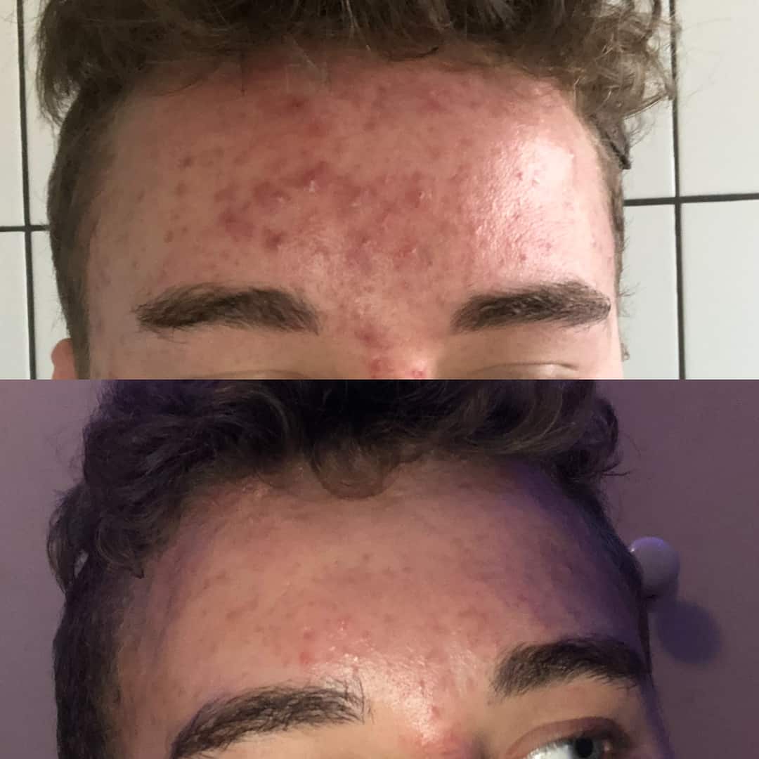 Dylan Before and After using SkinB5 Acne Control