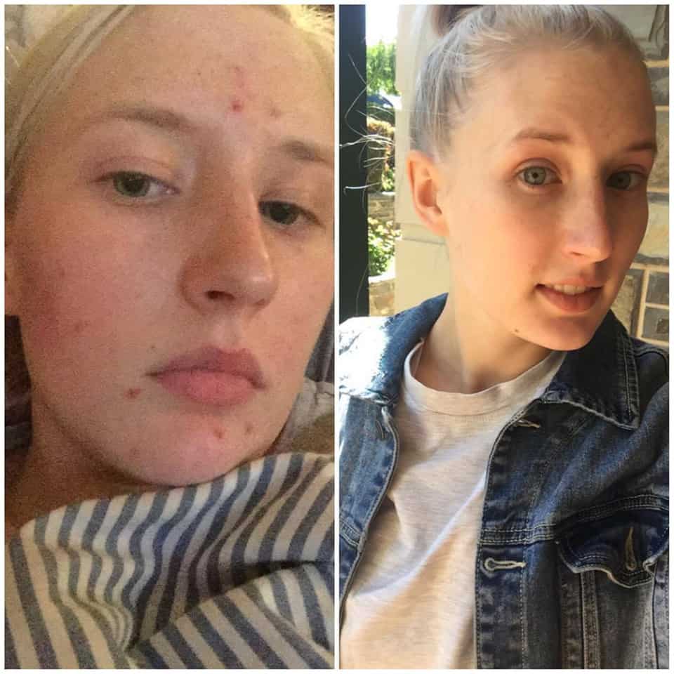 Kelsie McCandless Before and After using skinB5